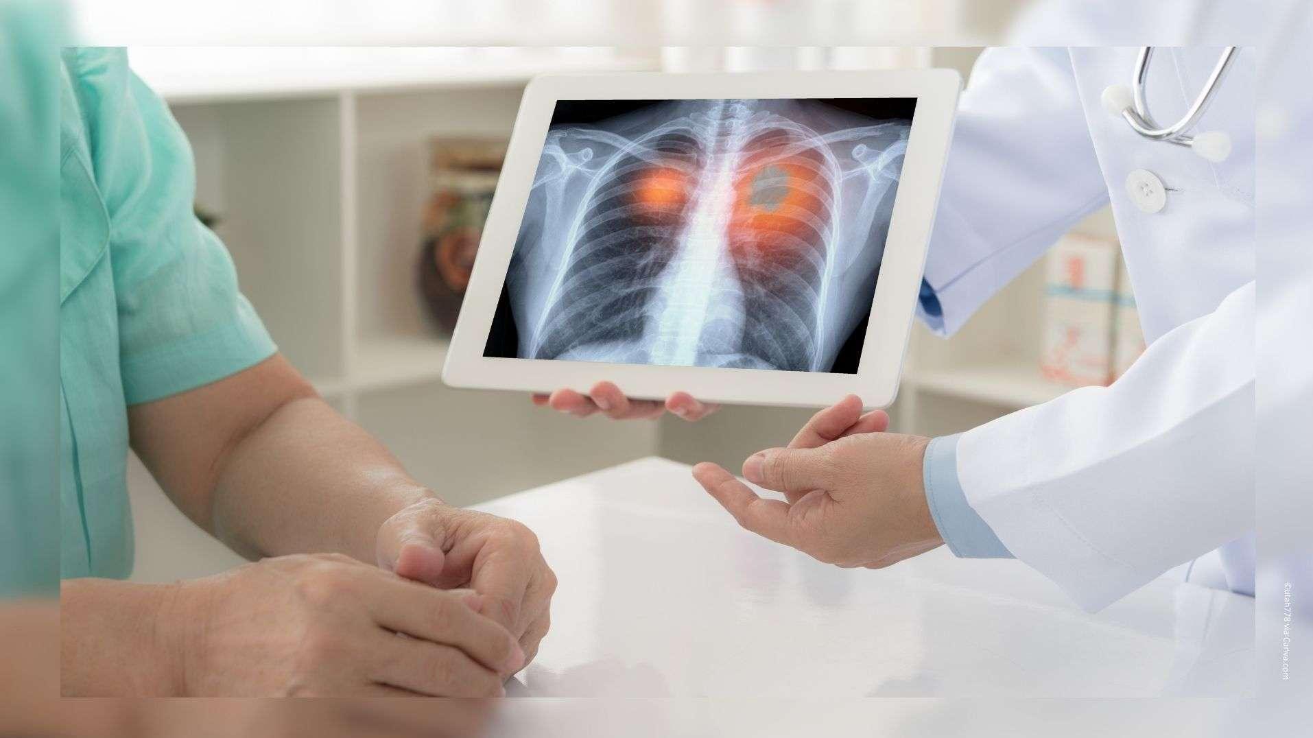 ARS PACA : six hôpitaux labellisés pour une prise en charge plus rapide du cancer du poumon